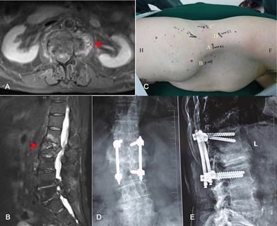 Da Vinci robot-assisted laparoscopic retroperitoneal debridement for lumbar septic spondylodiscitis: A two-case report